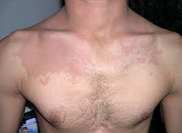 tinea versicolor