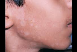 Pityriasis versicolor