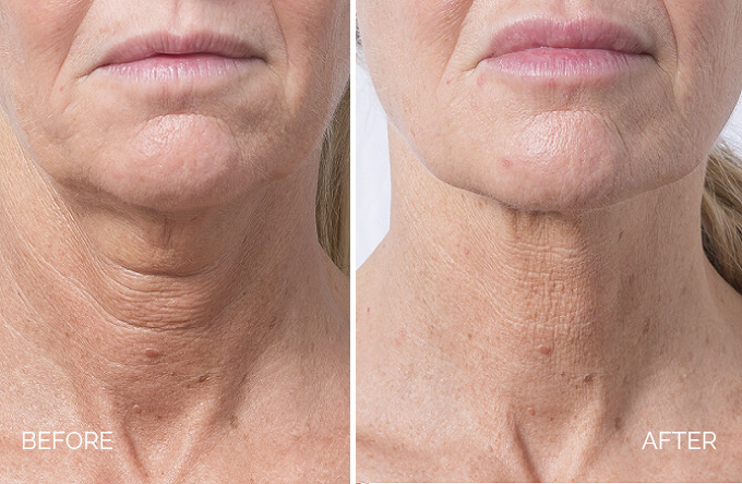 thread face lift